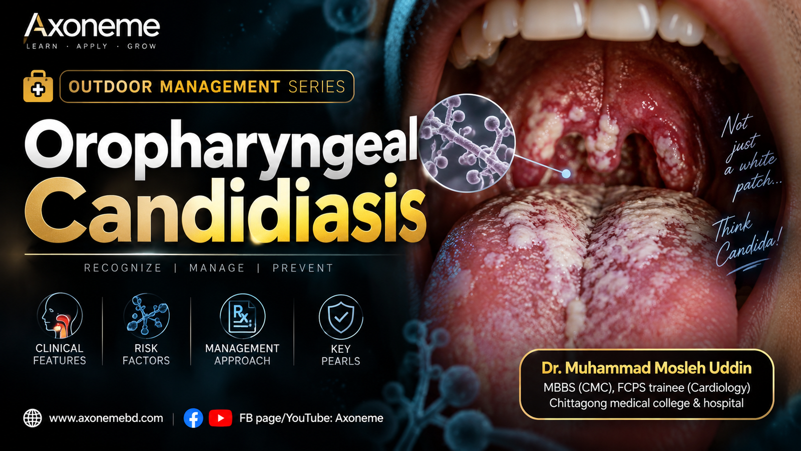 Oropharyngeal candidiasis